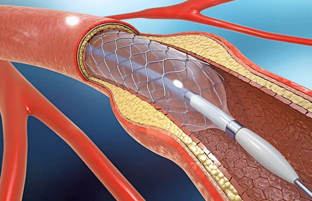 STENTING.jpeg